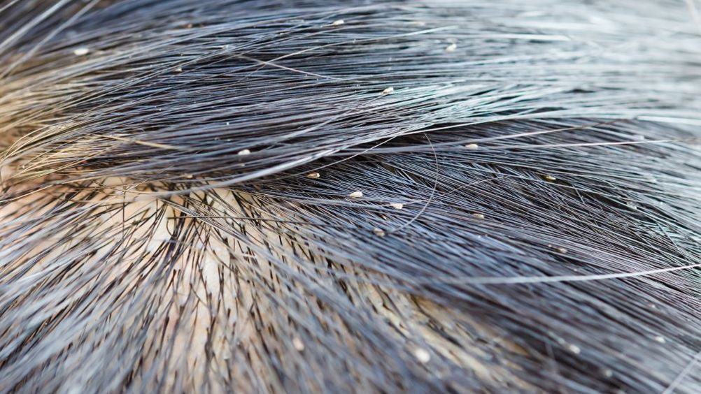 British Journal of Community Nursing Treating head lice: a case study