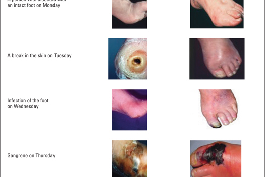 Figure 1. The speed at which an infection can evolve in the neuropathic foot and the ischaemic foot.