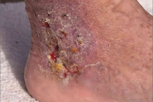 Figure 1. Cellulitis on the ankle of a patient