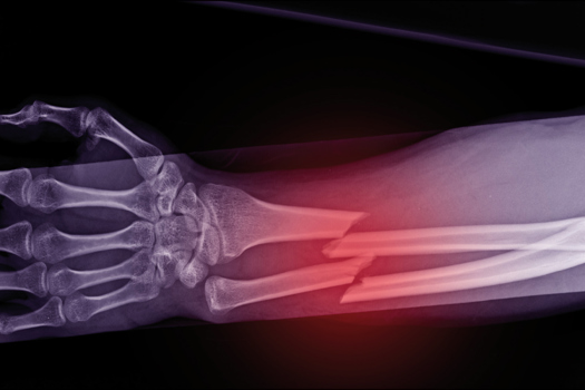  Fractures can have a significant impact on the physical, psychological and social wellbeing of the injured. Therefore, the overall aim of fracture management is to reduce the risk of complications and return the site to its full function.