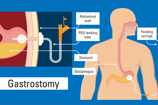 Figure 1. Percutaneous endoscopic gastrostomy